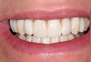 Brookfield Smiles Inc. | Implant Dentistry, Preventative Program and Veneers