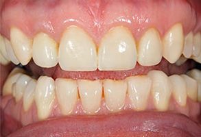 Brookfield Smiles Inc. | Dental Bridges, Crowns  amp  Caps and Teeth Whitening