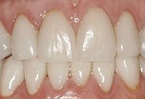 Brookfield Smiles Inc. | Oral Exams, Crowns  amp  Caps and Periodontal Treatment
