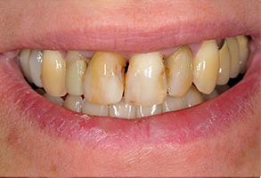 Brookfield Smiles Inc. | Crowns  amp  Caps, Veneers and Periodontal Treatment