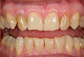 Brookfield Smiles Inc. | Dentures, Invisalign reg  and Periodontal Treatment