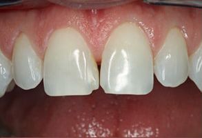 Brookfield Smiles Inc. | Veneers, Crowns  amp  Caps and Orthodontics